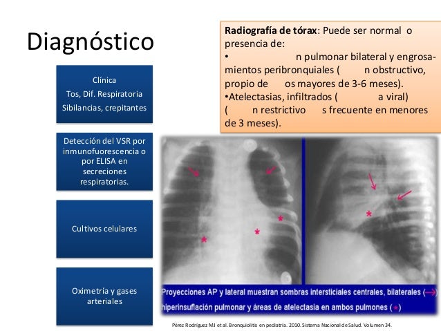 bronquitis en pediatria
